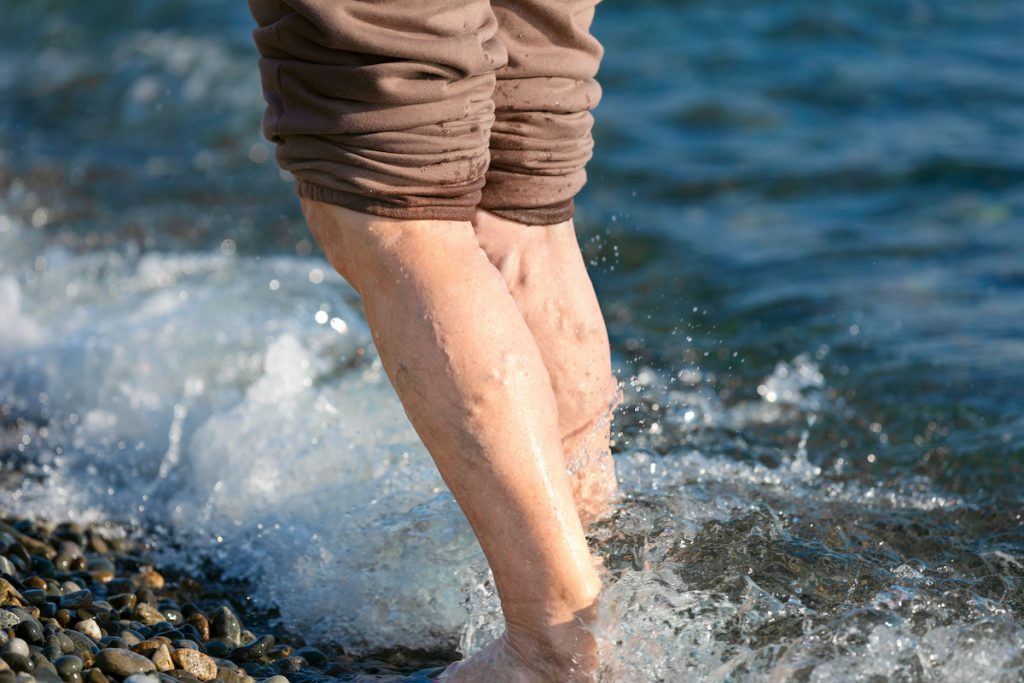 Legs of a mature woman with varicose veins